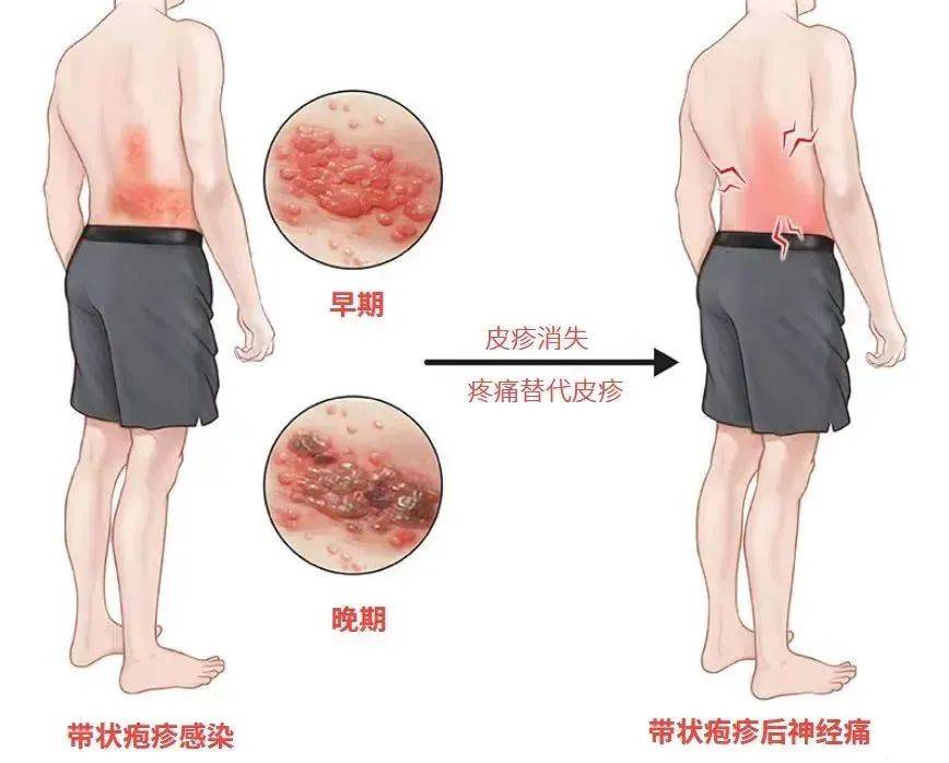 一旦感染终身携带<strong></p>
<p>屋里币</strong>!深圳疾控提醒:这4类人要注意