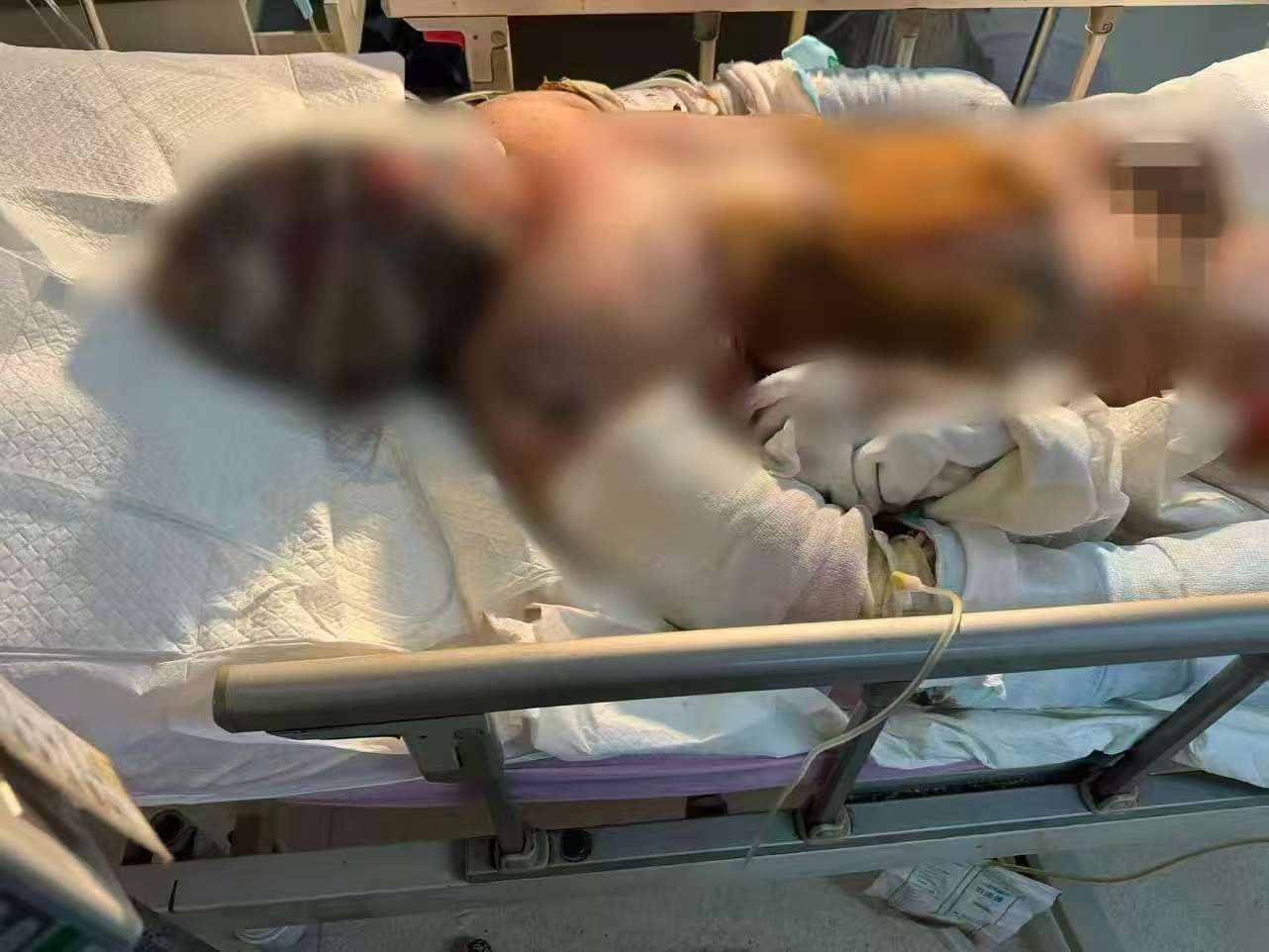 父子在哈尔滨一亲戚公司上班遇爆炸全身烧伤<strong></p>
<p>火特币</strong>，治疗花费近百万公司拒赔偿？亲戚回应