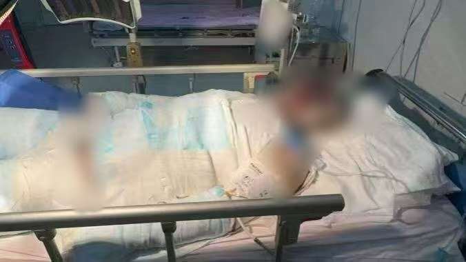 父子在哈尔滨一亲戚公司上班遇爆炸全身烧伤<strong></p>
<p>火特币</strong>，治疗花费近百万公司拒赔偿？亲戚回应