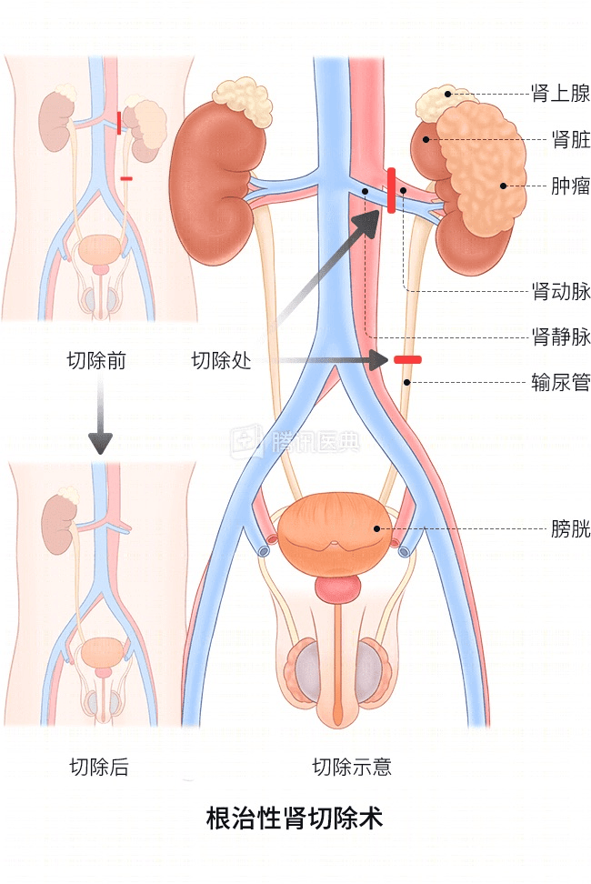 “感觉天塌了”！深圳女孩5岁患癌<strong></p>
<p>虎币</strong>，爸妈决定：为她冻存卵巢组织